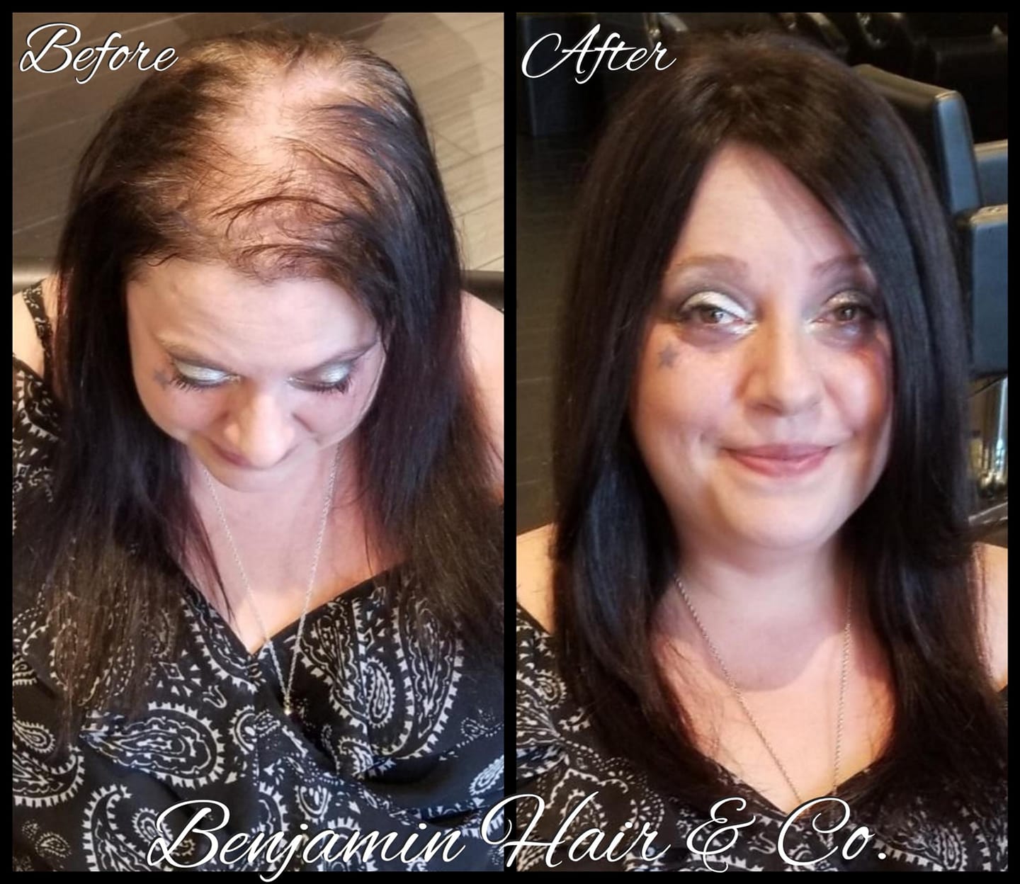 Common Reasons of Hairloss & Their Most Chosen Solutions Common Reasons of Hairloss & Their Most Chosen Solutions